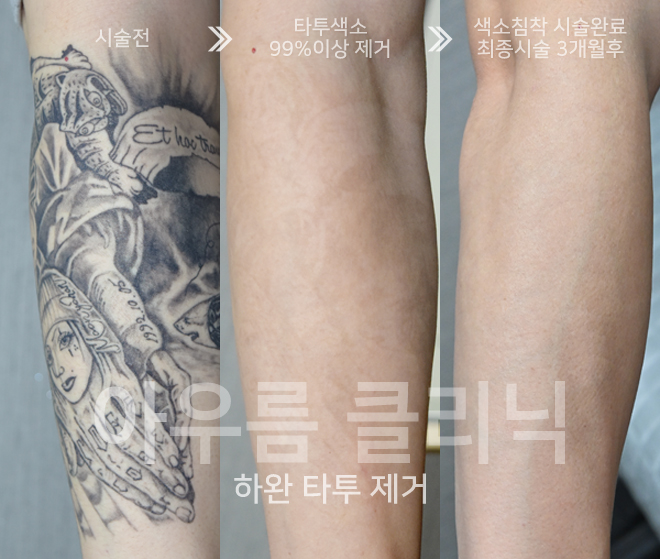 강남 타투제거 전에 알아두는 잉크 성분과 몸이 색소를 처리하는 과정 - 아우름의원