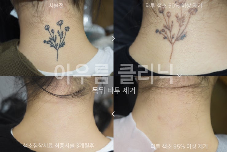 문신제거비용 계획과 함께 짚어보는 상담부터 마무리까지 단계 — 아우름의원