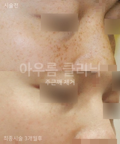 발생부위