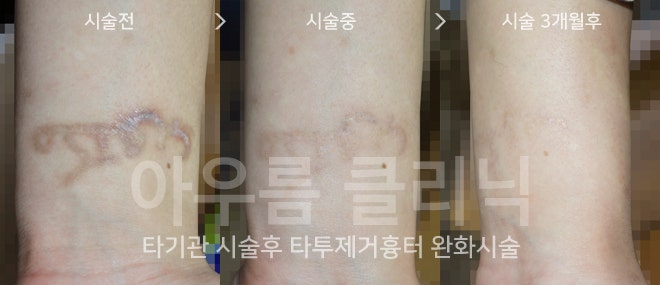 튼살·흉터와 색소 질환의 차이, 아우름의원에서 살펴보기 — 아우름의원