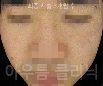 부위관찰