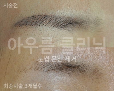 색소반응