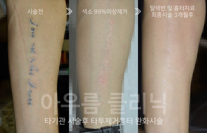 문신제거 시기를 정할 때 함께 살펴보는 계절과 자외선 조건 — 아우름의원