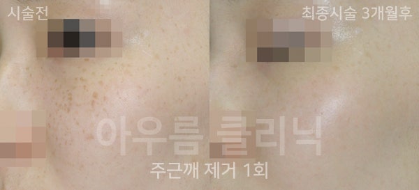 피부 관찰