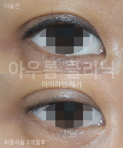시술 준비