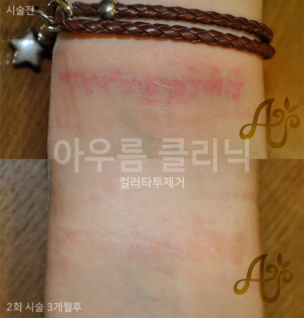 문신제거병원 상담 전에 정리해 두면 좋은 문진 항목과 준비 사항 - 아우름의원