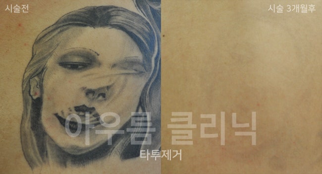 회복단계