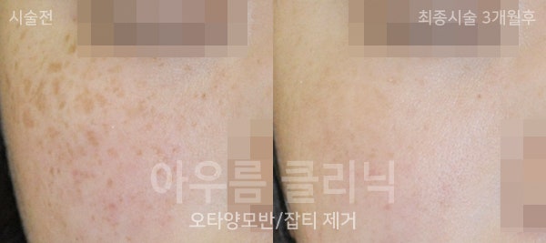 색소분포