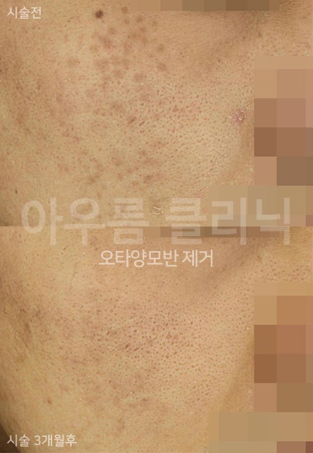 피부관찰