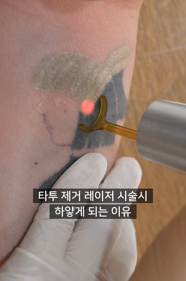 문신제거 당일 진행 순서와 통증 관리 방법 살펴보기 — 아우름의원