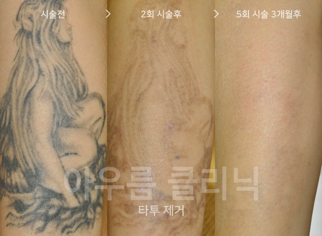 부위확인