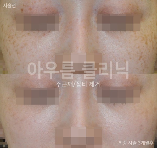 기미잡티가 다시 진해지는 이유와 재발을 줄이는 생활 관리법 — 아우름의원