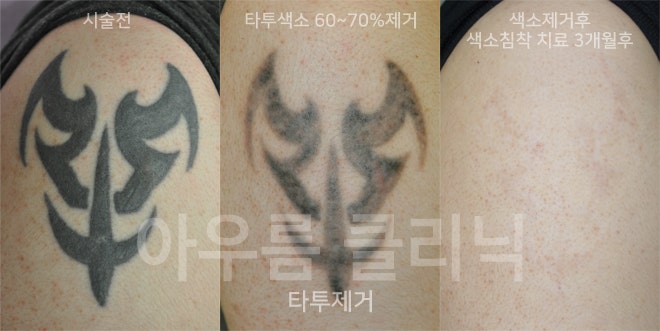 경과관찰