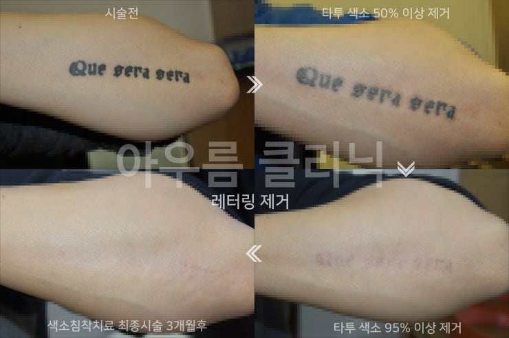 타투제거가 비급여로 분류되는 이유와 보험 적용 범위를 확인하는 방법 - 아우름의원