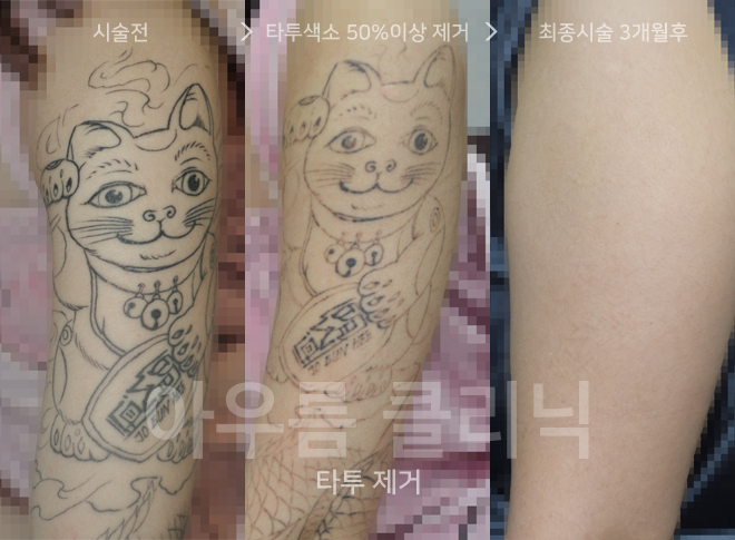 강남역문신제거 후 나타날 수 있는 일시적 색소 변화와 흉터 관리 — 아우름의원
