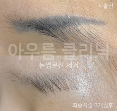 회복 경과