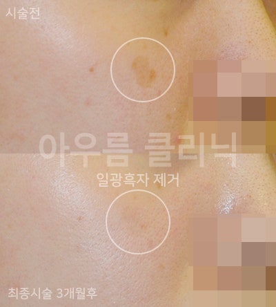 기미잡티와 주근깨·검버섯 구분 기준, 색으로 비교하는 법 — 아우름의원