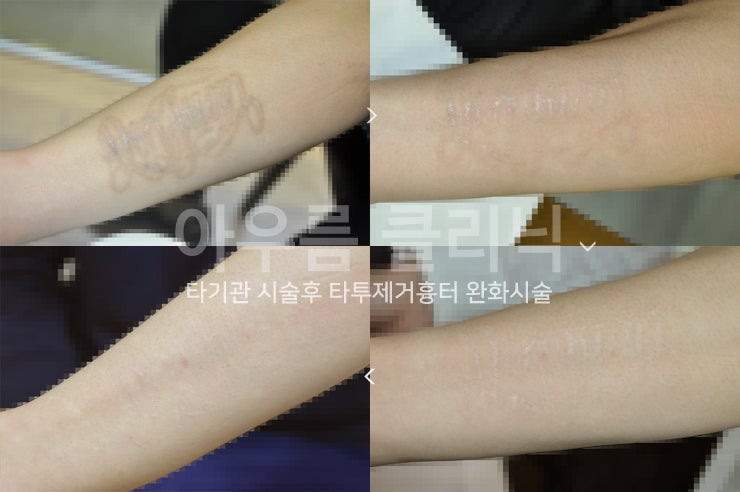 레이저 조사
