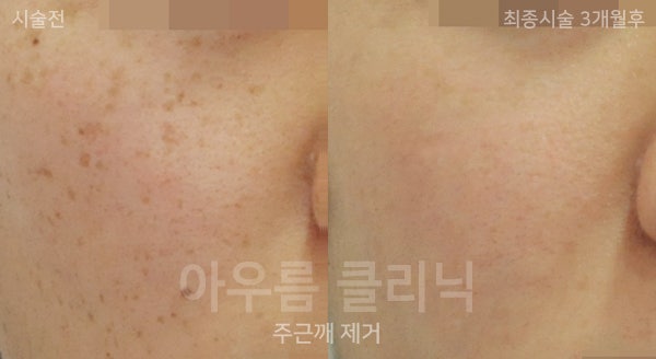 진단기준