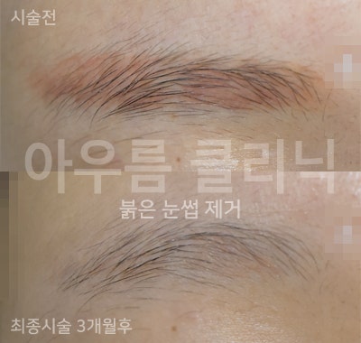 회복단계