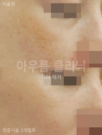 피부 상태