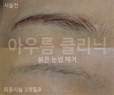 눈썹문신제거 시기를 정할 때 계절과 야외 일정을 함께 보는 이유 — 아우름의원