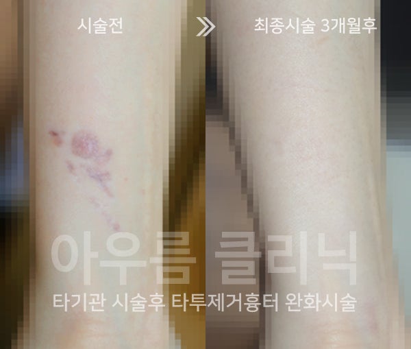 타투제거를 앞두고 자주 오해하는 자가 처리 방법과 피부 손상 — 아우름의원