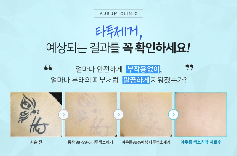 레이저 조사