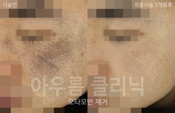 색소분포