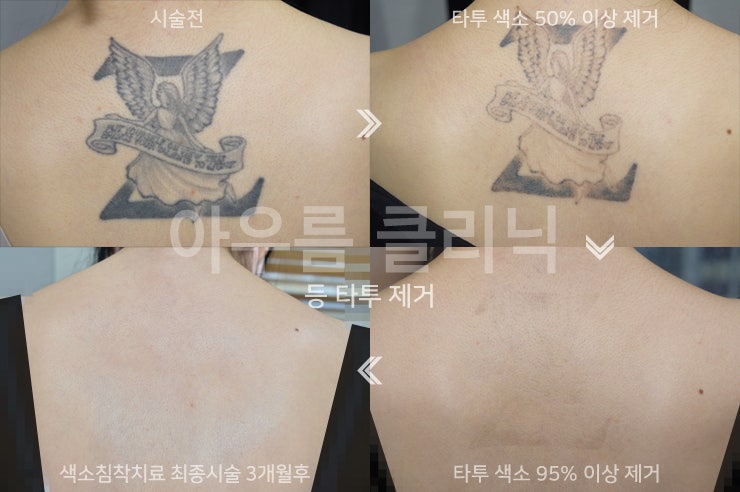 흉터관리