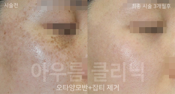 피코레이저 반응이 피부 타입별로 다른 이유 — 아우름의원
