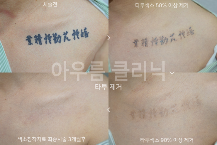 강남역문신제거 계획을 좌우하는 부위별 피부 두께 차이 — 아우름의원