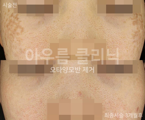 색소 분포