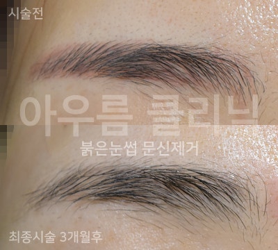 레이저 조사