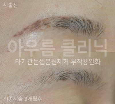 시술 준비