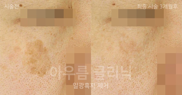 부위표시