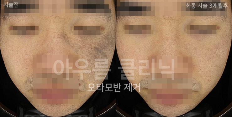 피부관찰