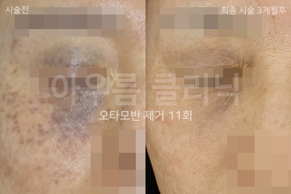 색조변화