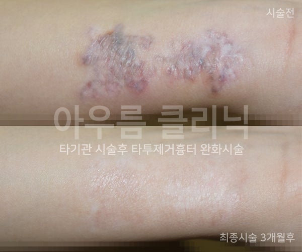 재시술판단