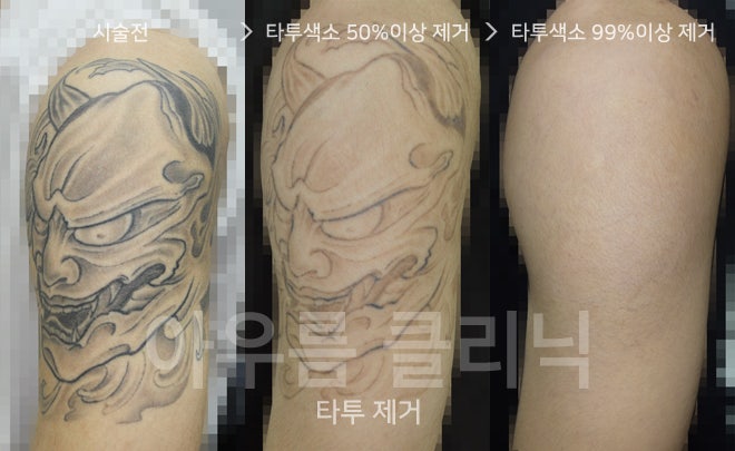 문신제거레이저와 절제·박피 방식은 무엇이 다른지 비교해 보기 — 아우름의원