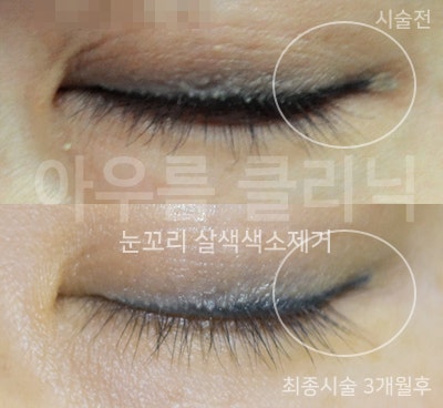 피부 상태