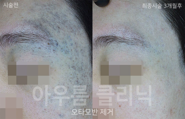 치료전후