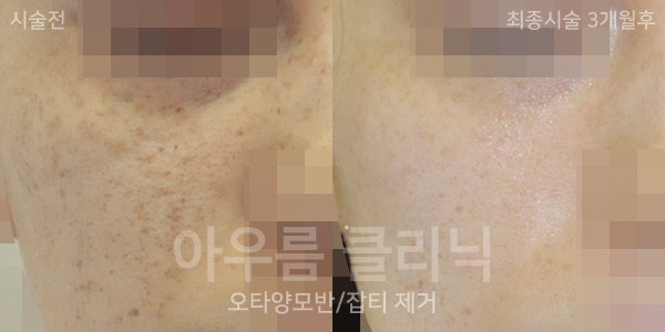 부위표시