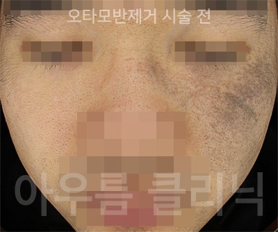 오타모반은 언제 나타나고 시간이 지나며 어떻게 변할까 - 아우름의원