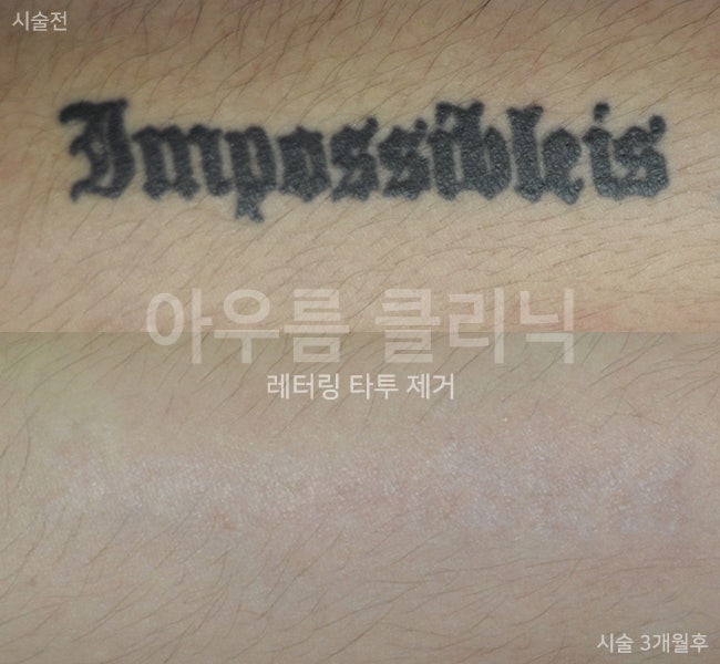 색소반응