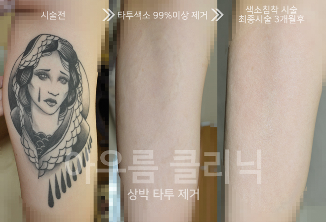 강남역문신제거 횟수를 결정짓는 색소 깊이와 잉크 색상의 차이 — 아우름의원