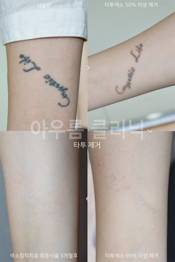 부위확인