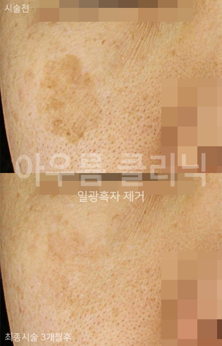 시술 준비