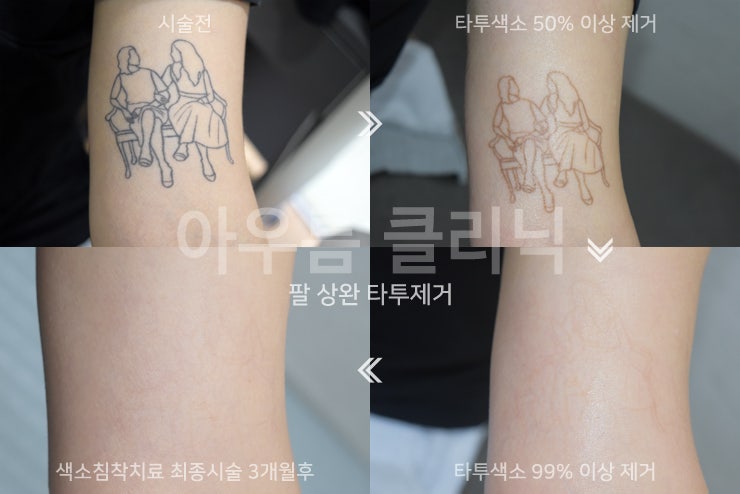 피부재생