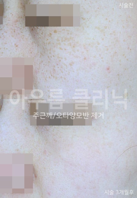 주근깨레이저가격 상담 전에 정리해두면 좋은 치료 계획 요소 - 아우름의원
